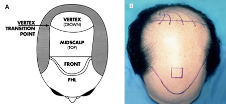 Follicular Unit Transplantation - Schematic of the regions of the scalp