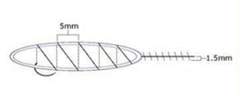 Follicular Unit Transplantation - Schematic of suturing technique