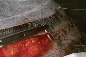 Follicular Unit Transplantation - Suturing technique showing suture placement