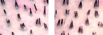 Follicular Unit Transplantation - Densitometry showing discrete natural groups as the hair emerges from the scalp