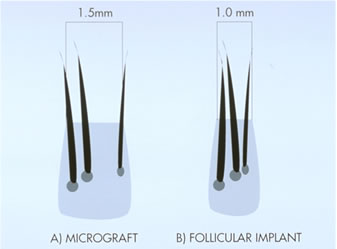 Follicular Unit Transplantation - Densitometry showing discrete natural groups as the hair emerges from the scalp