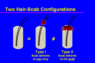 Graft Anchoring in Hair Transplantation - Hair-scab configurations