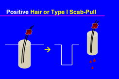 Graft Anchoring in Hair Transplantation - Positive hair-pull