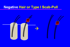 Graft Anchoring in Hair Transplantation - Negative hair-pull