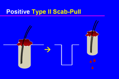 Graft Anchoring in Hair Transplantation - Positive scab-pull