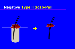 Graft Anchoring in Hair Transplantation - Negative scab-pull