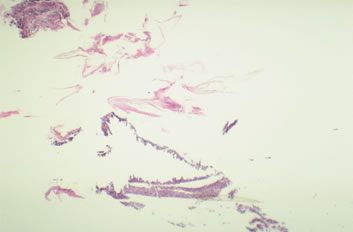 Graft Anchoring in Hair Transplantation - Day 10: Scale-crust and hair shaft – Interpretation: Negative