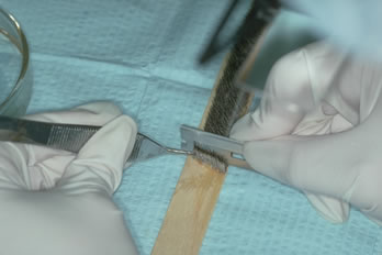 Follicular Unit Graft Yield - Vertical Sectioning