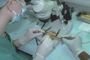 Follicular Unit Graft Yield - Follicular Unit Transplantation - Single-Strip Harvesting followed by Stereo-microscopically controlled Slivering