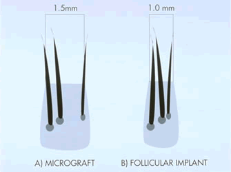 Guide to Hair Restoration - Follicular Unit Grafts