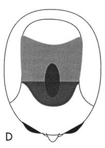 Figure 1d - Bernstein RM, Rassman WR: The Aesthetics of Follicular Transplantation. Dermatol Surg 1997; 23: 785-99.