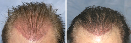 Follicular Unit Transplantation