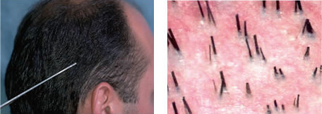 Miniaturization of Hair Shafts in Androgenetic Alopecia