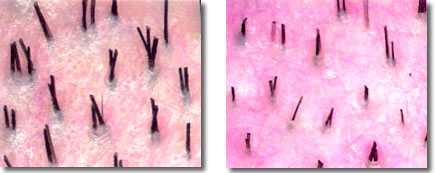 Miniaturization (left), normal scalp (right)