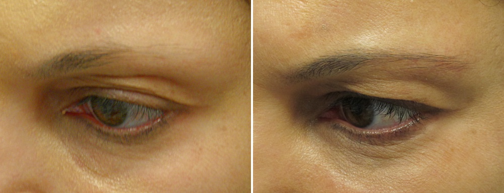 Latisse for eyebrows deals