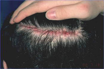 Scalp Laxity Paradox - Widened donor scar at time diagnosis of EDS was considered