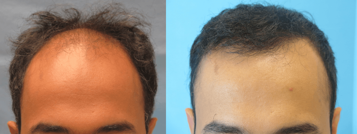 Bernstein Medical - Patient LBL Before and After Hair Transplant Photo