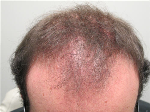Lichen planopilaris (LPP) is a type of scarring alopecia that presents in adulthood