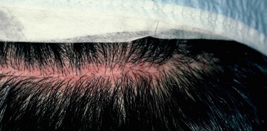 Linear Scar in FUT Hair Transplant