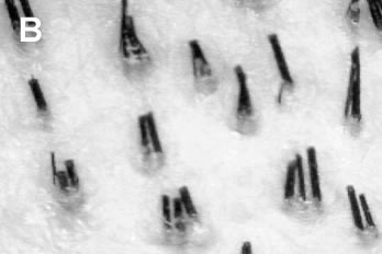 Logic of Follicular Unit Transplantation - Natural follicular groupings in the donor scalp - Average density