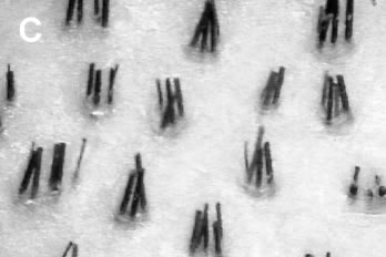 Logic of Follicular Unit Transplantation - Natural follicular groupings in the donor scalp - Very high density