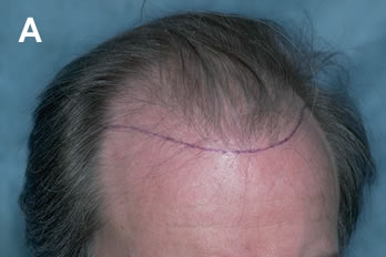 Logic of Follicular Unit Transplantation - 48 year old male with a thinning Norwood Class VA