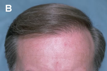 Logic of Follicular Unit Transplantation - 48 year old male with a thinning Norwood Class VA - After hair transplant procedure of 2,803 follicular units