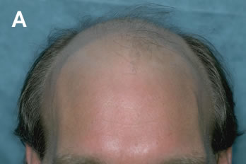 Logic of Follicular Unit Transplantation - Middle aged male with a Norwood Class VI balding pattern