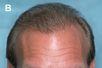 Logic of Follicular Unit Transplantation - Middle aged male with a Norwood Class VI balding pattern - After one hair transplant session of 2,292 follicular units