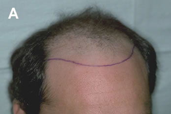 Logic of Follicular Unit Transplantation - 36 year old male with early Norwood Class Va/VI balding pattern