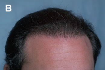 Logic of Follicular Unit Transplantation - 36 year old male with early Norwood Class Va/VI balding pattern - After two procedures of follicular unit transplantation