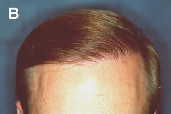 Logic of Follicular Unit Transplantation - 38 year old male Norwood Class Va/VI - After two procedures of follicular unit transplantation