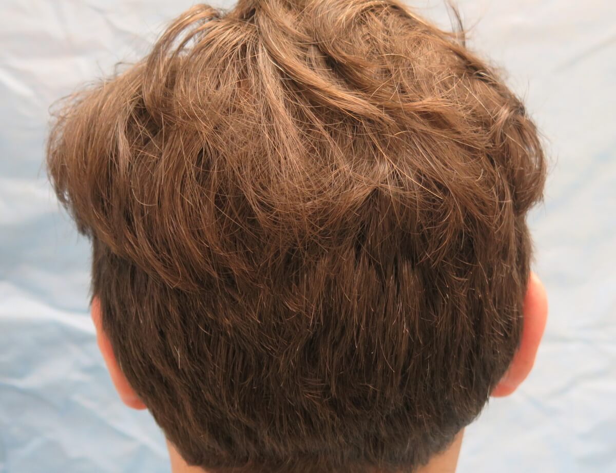 Long-Hair Robotic FUE | ARTAS Hair | Bernstein Medical Long-Hair Robotic FUE | ARTAS Hair | Bernstein Medical