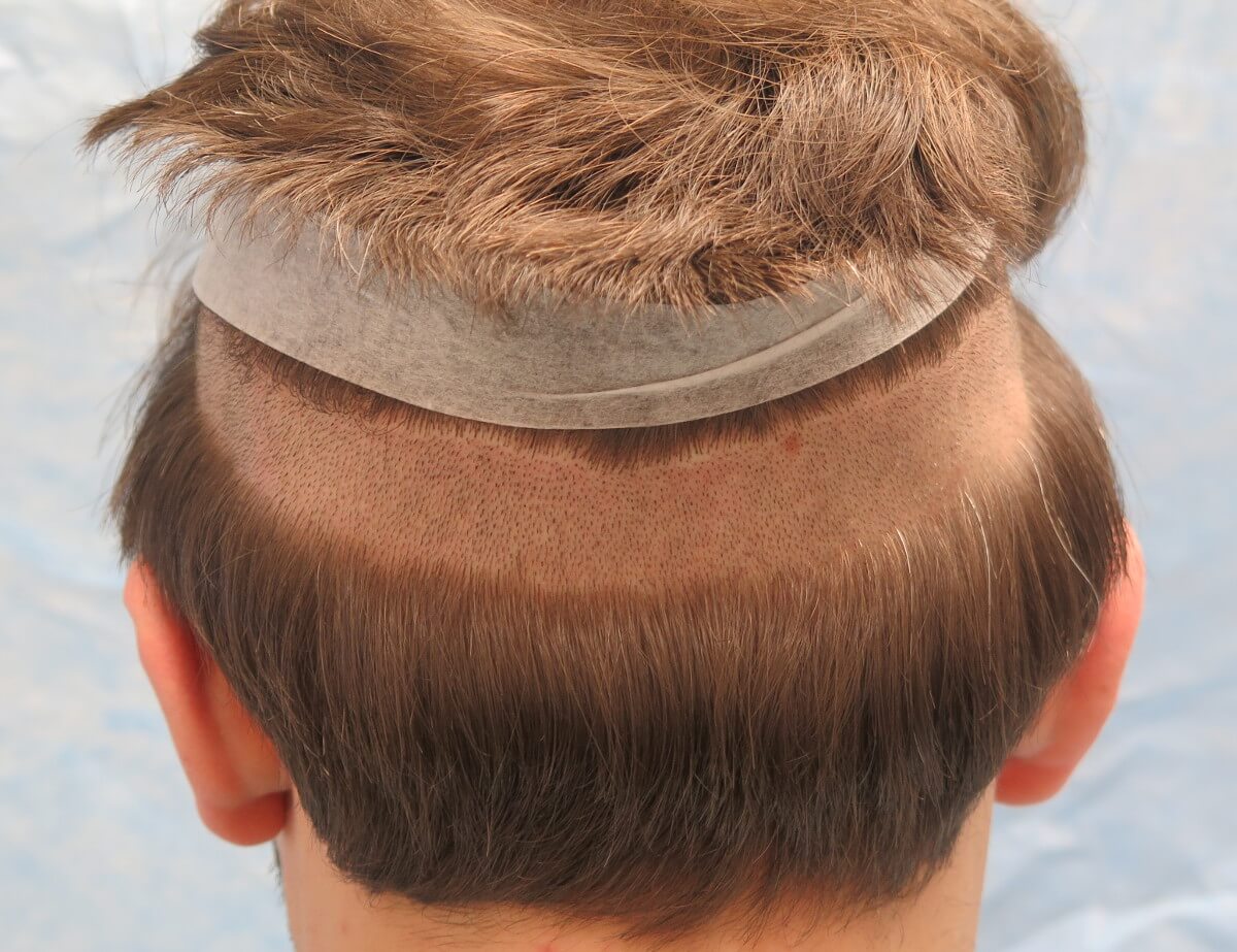 Long-Hair Robotic FUE | ARTAS Hair | Bernstein Medical Long-Hair Robotic FUE | ARTAS Hair | Bernstein Medical