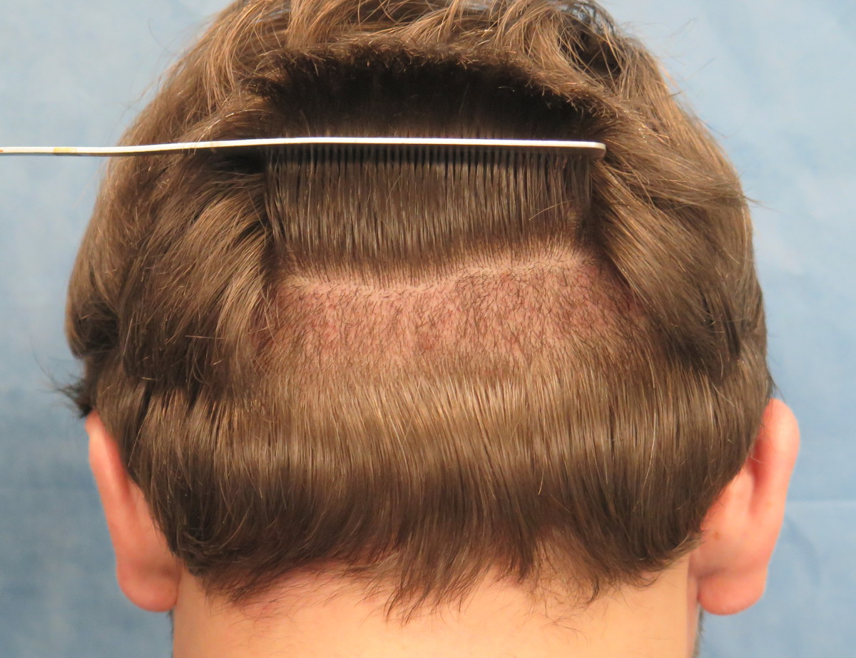 Long-Hair Robotic FUE | ARTAS Hair | Bernstein Medical