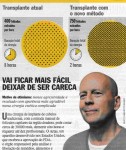 Dr. Bernstein, ARTAS Robot for FUE in Brazil's Veja Magazine