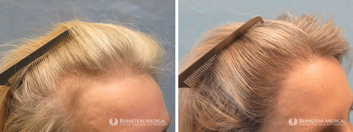 Bernstein Medical - Patient GDJ Before and After Hair Transplant Photo 
