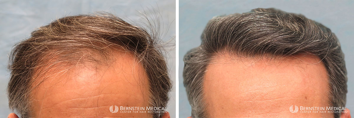 Bernstein Medical - Patient JAJ Before and After Hair Transplant Photo 