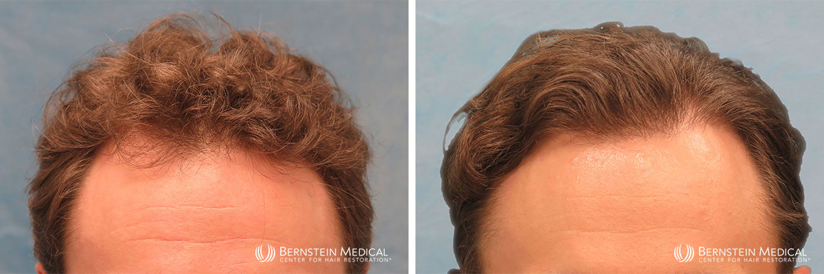 Bernstein Medical - Patient AKZ Before and After Hair Transplant Photo 