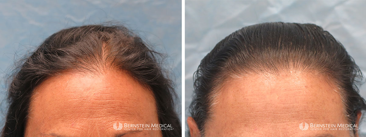 Bernstein Medical - Patient EHC Before and After Hair Transplant Photo 