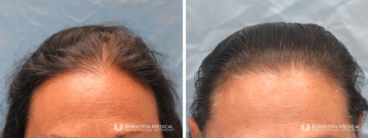 Bernstein Medical - Patient EHC Before and After Hair Transplant Photo