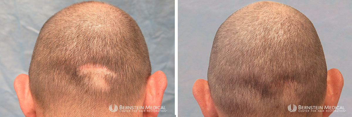 Bernstein Medical - Patient LFS Before and After Hair Transplant Photo 