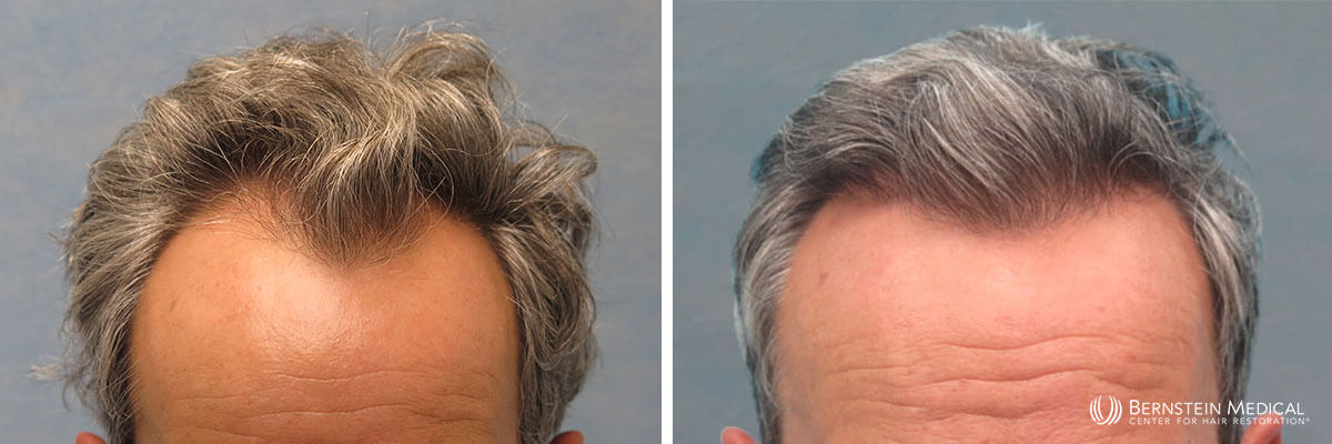 Bernstein Medical - Patient KBI Before and After Hair Transplant Photo 