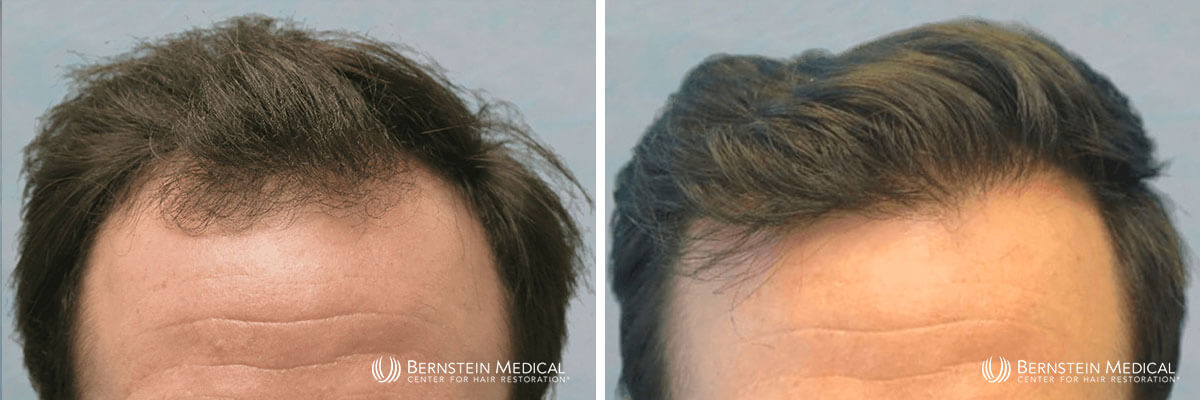 Bernstein Medical - Patient KJC Before and After Hair Transplant Photo 