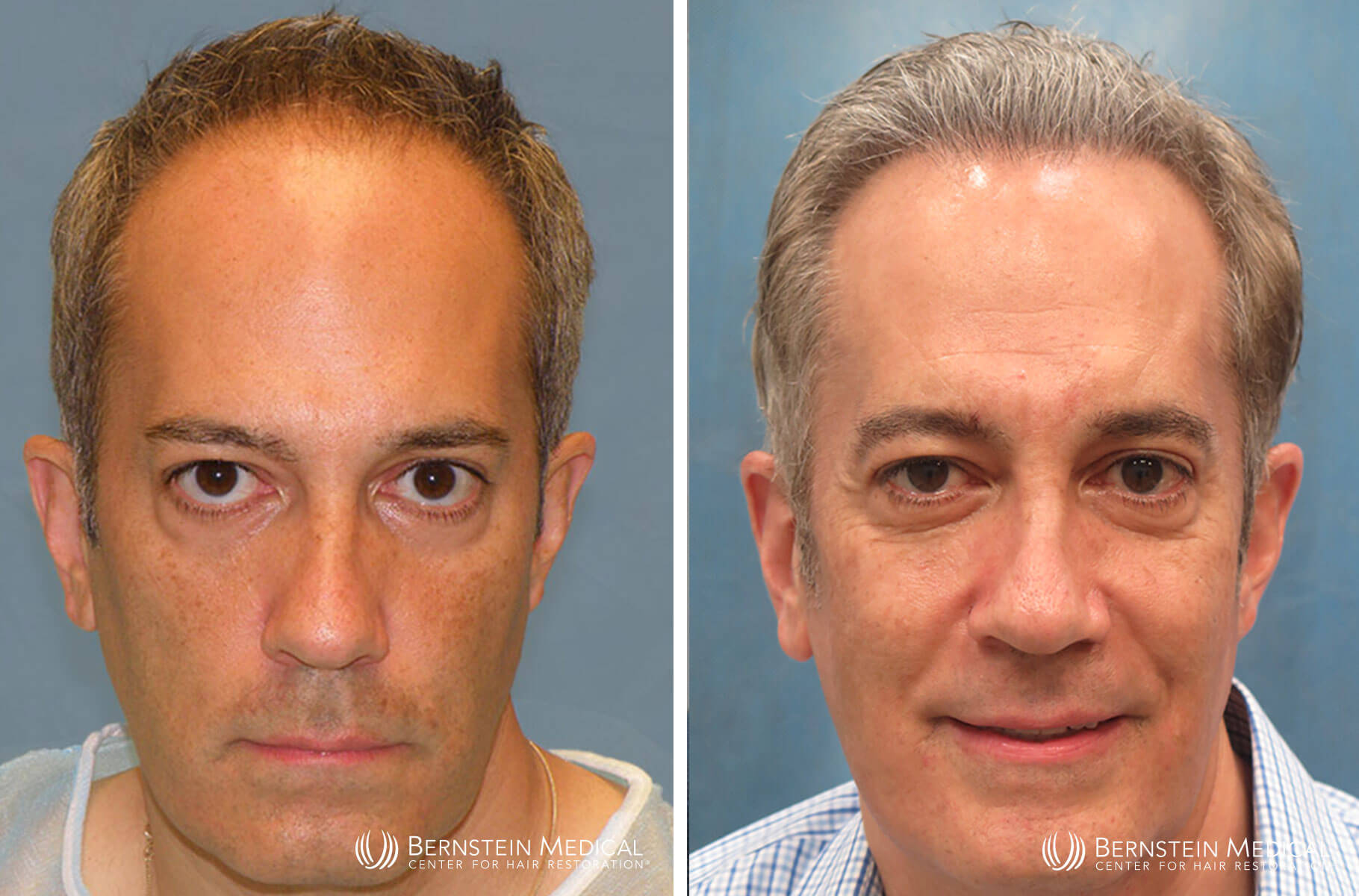 Bernstein Medical - Patient RGI Before and After Hair Transplant Photo 