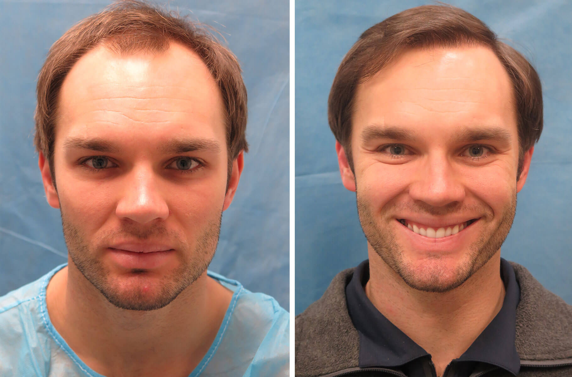 Bernstein Medical - Patient FAL Before and After Hair Transplant Photo 