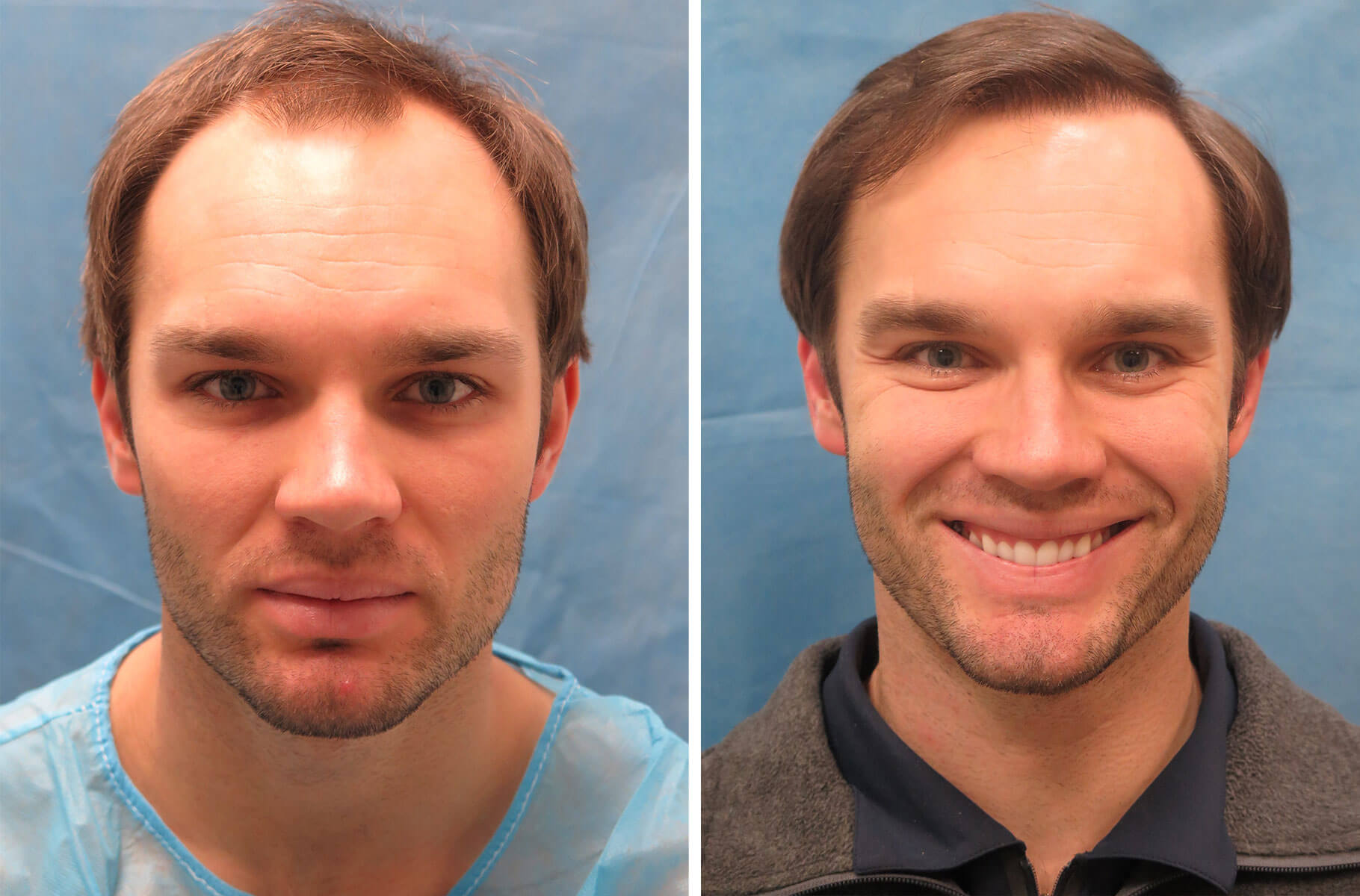 Bernstein Medical - Patient FAL Before and After Hair Transplant Photo