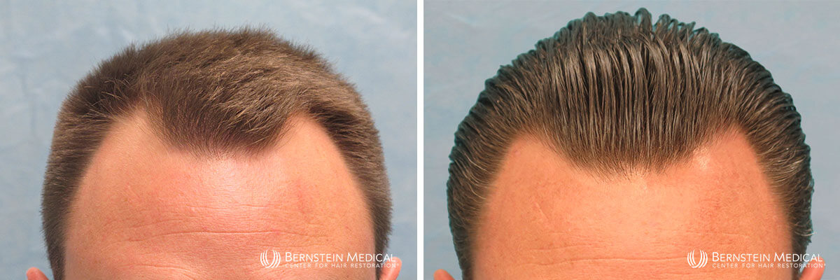 Bernstein Medical - Patient MJE Before and After Hair Transplant Photo