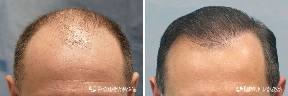 Bernstein Medical - Patient SCZ Before and After Hair Transplant Photo