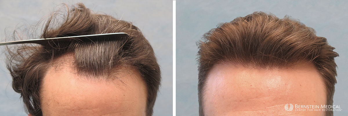 Bernstein Medical - Patient CDQ Before and After Hair Transplant Photo 